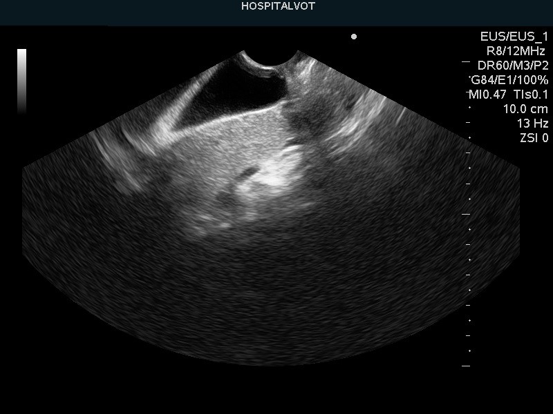 Ecoendoscopia: ¿Que es y para que sirve?