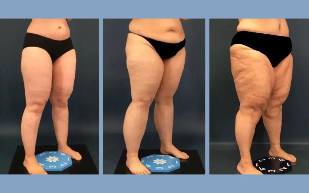 Los grados del lipedema