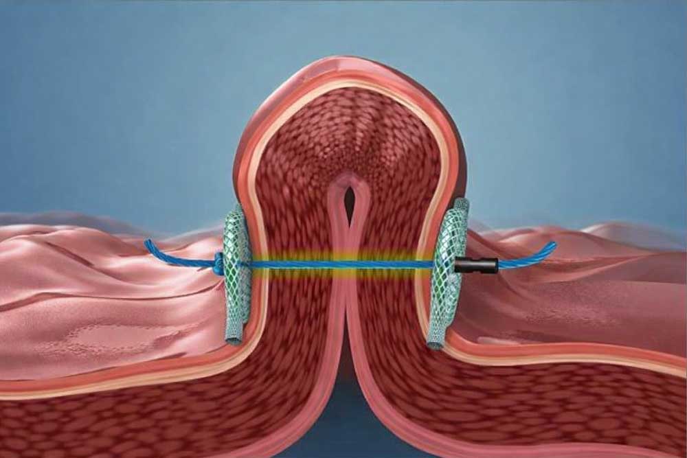 ¿Que es el Metodo POSE? Opcion para la perdida de peso