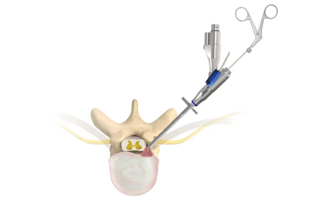 Endoscopia de columna: que es y aplicaciones