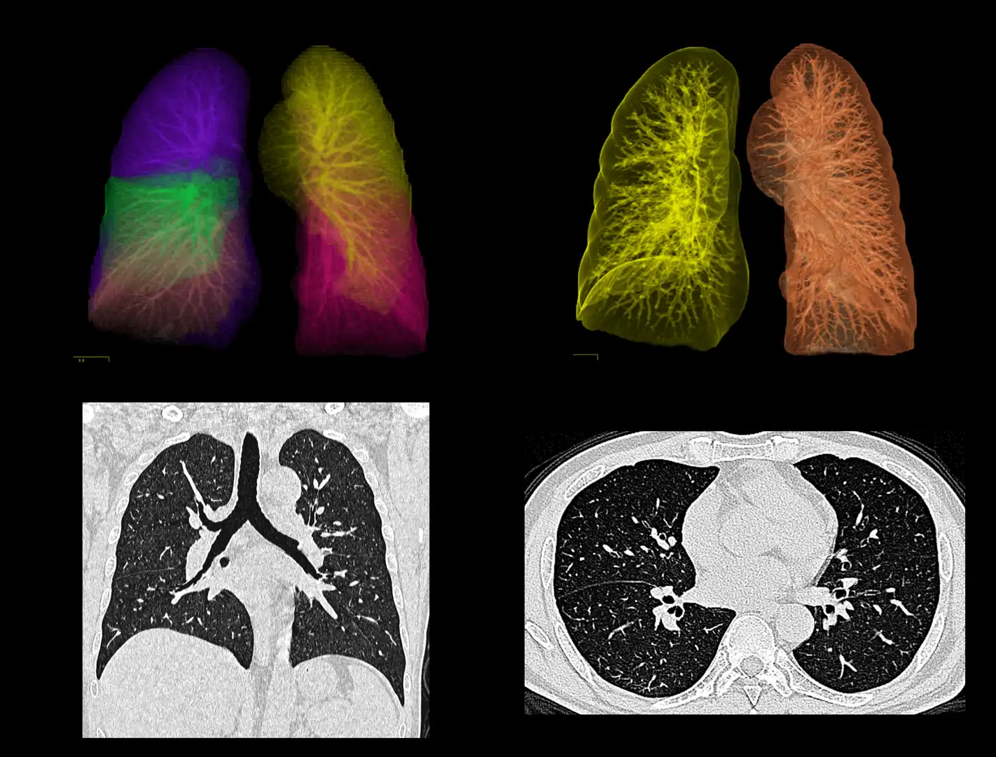analisis-densidad-pulmonar-tac-hospital-vot-madrid
