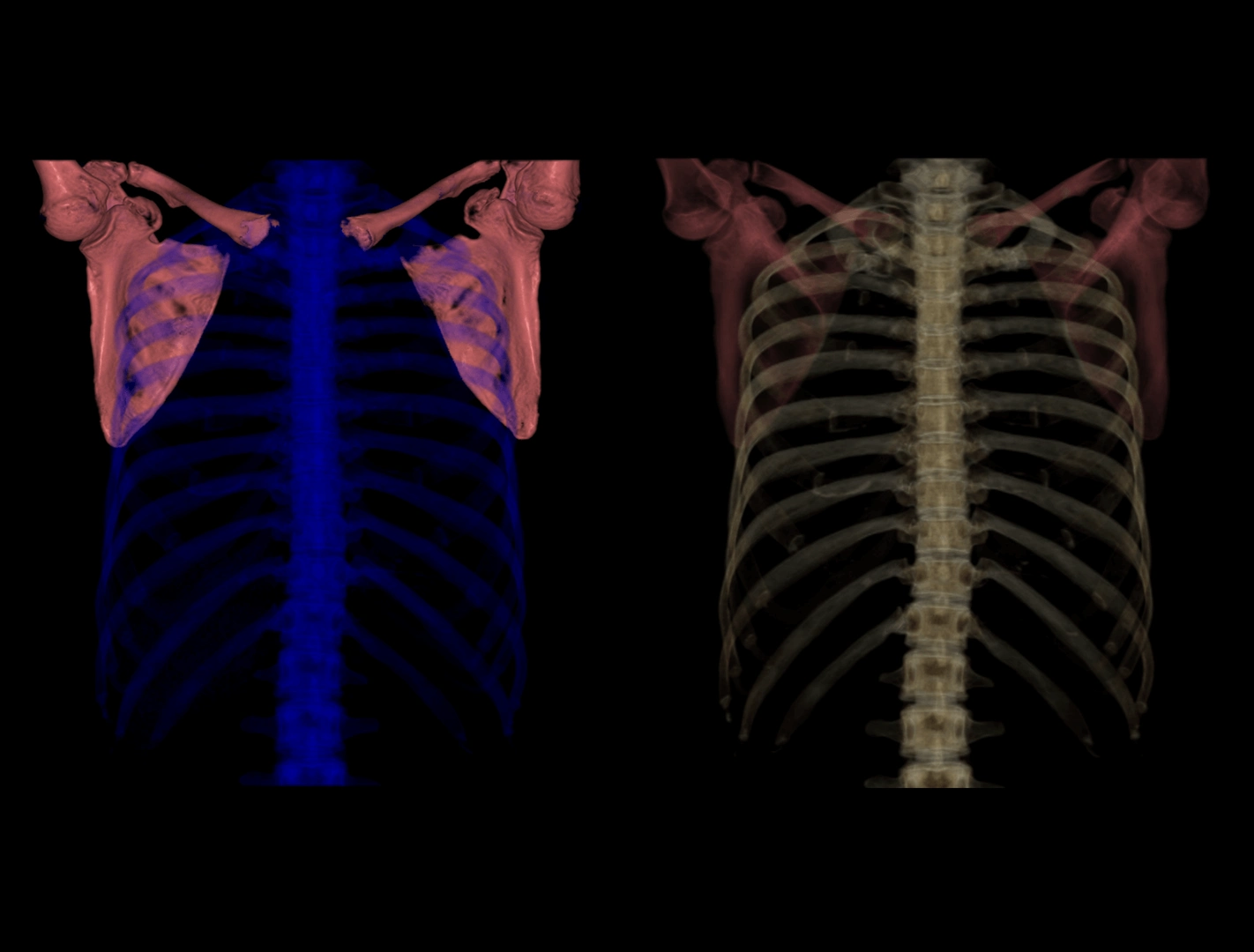 tac-3d-articulacion-hombro-hospital-vot-madrid