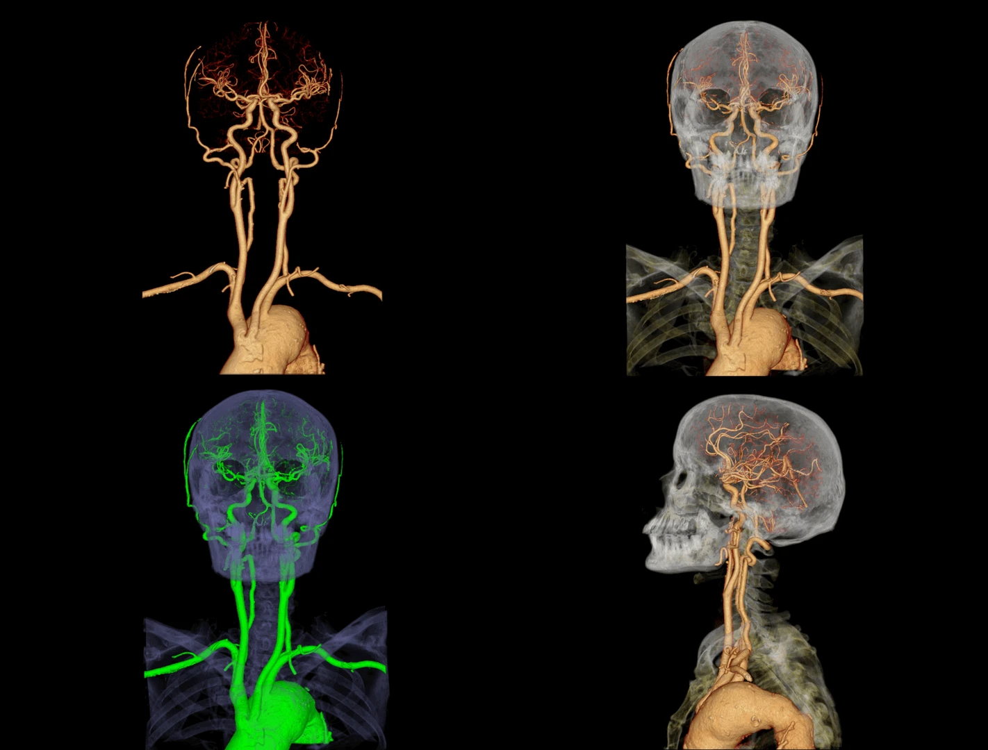tac-cabeza-cuello-angiografia-hospital-vot-madrid
