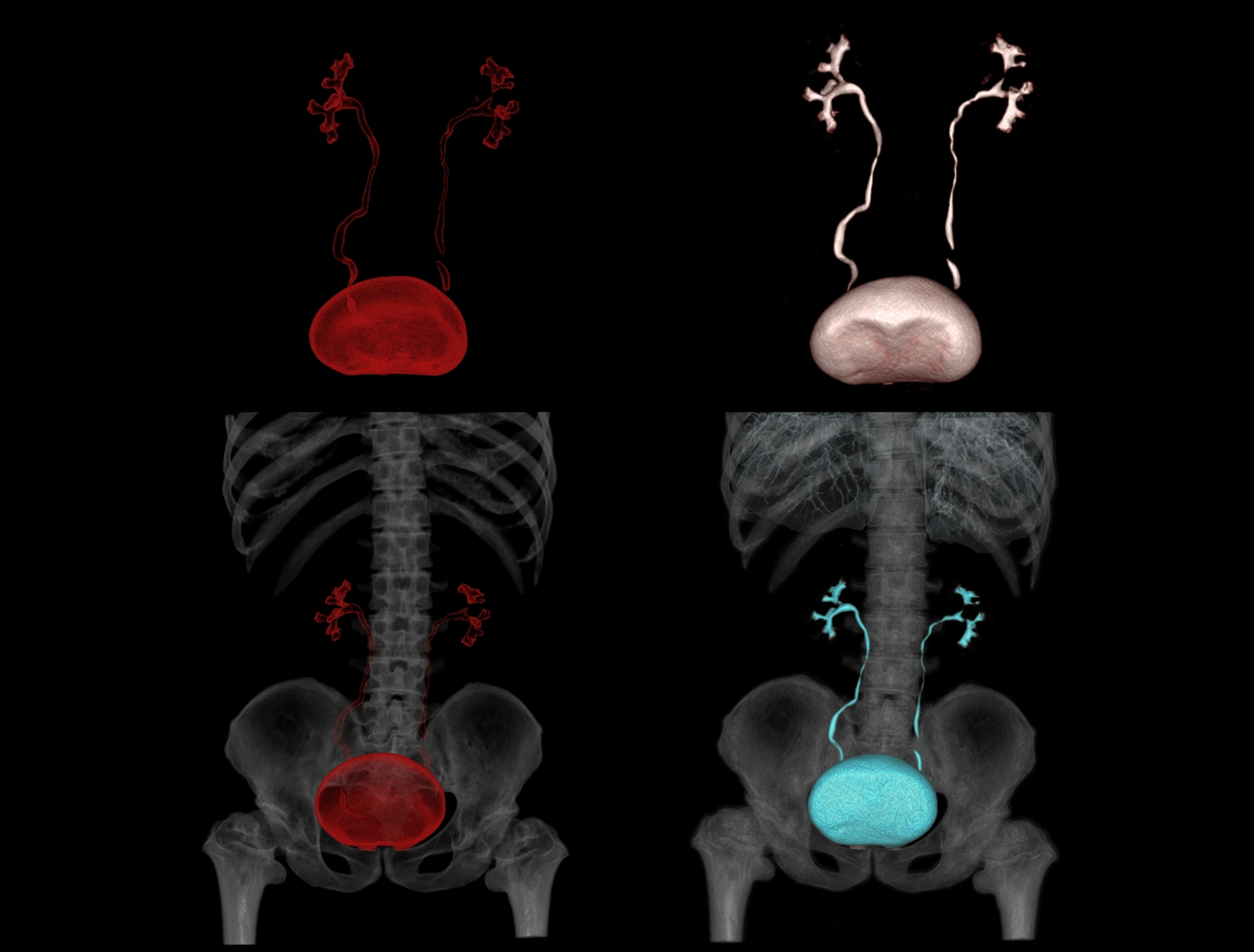 urotac-ctu-aparato-urinario-hospital-vot-madrid