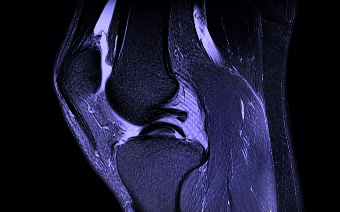 Rotura de menisco en asa de cubo: una lesion meniscal que requiere intervencion precoz
