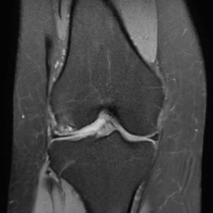 Resonancia magnética 3 Teslas en Madrid: corte coronal de rodilla obtenido en el Hospital de la VOT