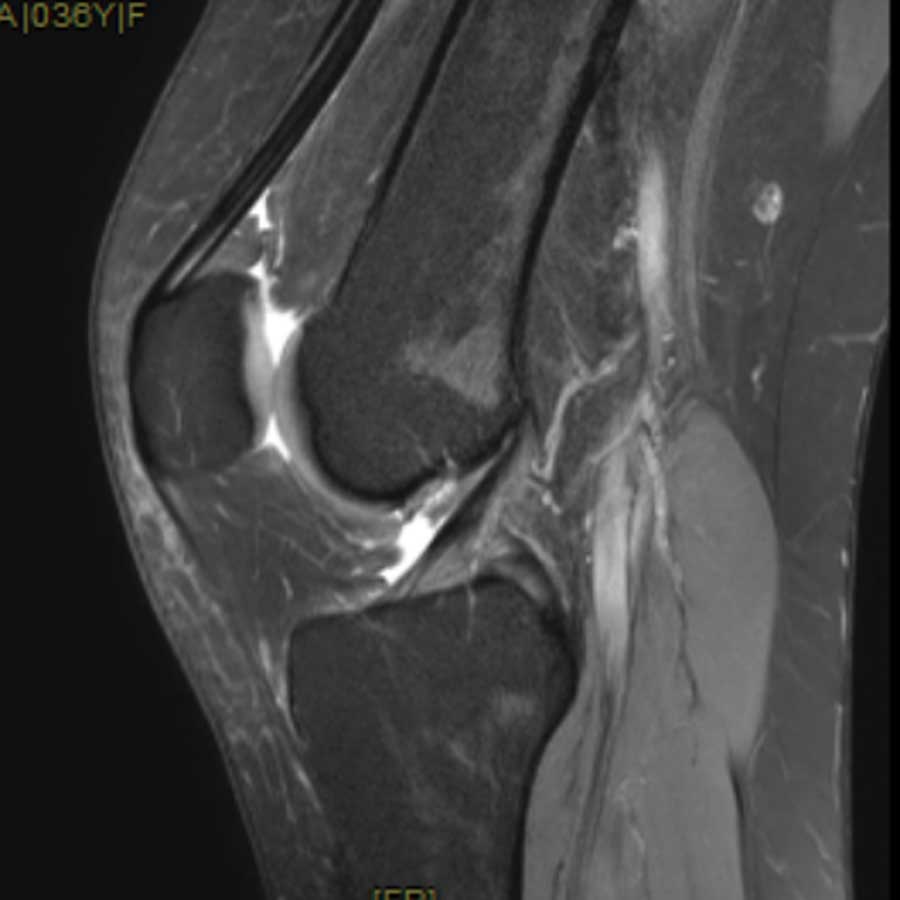 Corte sagital de rodilla en resonancia magnética 3T de alta resolución