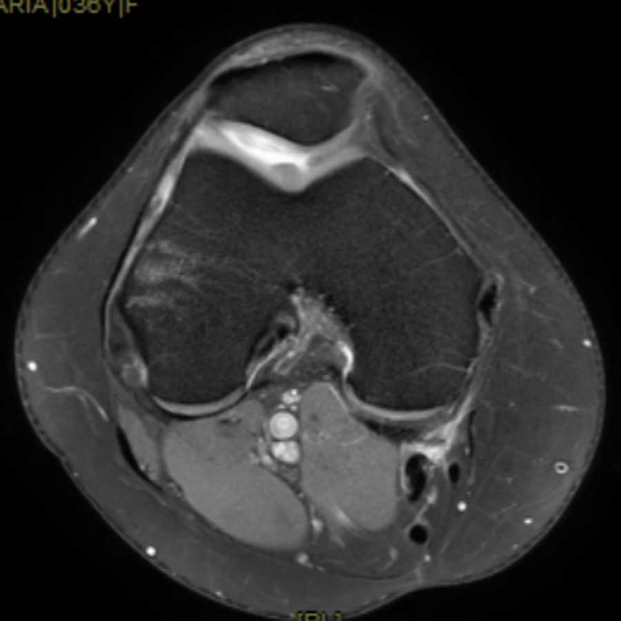 Estudio musculoesquelético de rodilla en plano axial con resonancia magnética 3 Teslas