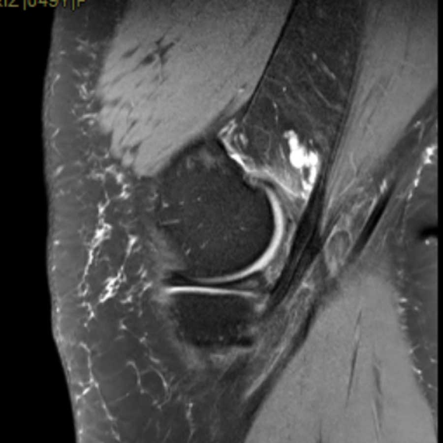 Detalle anatómico de rodilla obtenido con resonancia magnética de alta resolución en Madrid